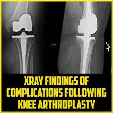 Image result for Knee XRay