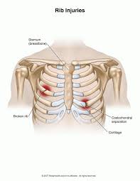 Pin On Natural Herbs For Costochondritis Treatment