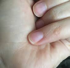 Black dot on nail cuticle. Tiny Black Spot On Nail Freaking Out Babycenter