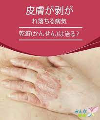 皮膚が剥がれ落ちる病気 乾癬 かんせん は治る みんな健康 乾癬 自然療法 皮膚
