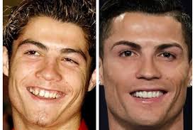 Златан ибрагимович и пластика носа 3. Znamenitye Muzhchiny Kotorye Delali Plastiku