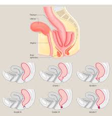 Image result for Rectal prolapse