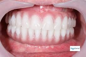 Denture Implants Vs Fixed Bridge Teeth Replacement Options