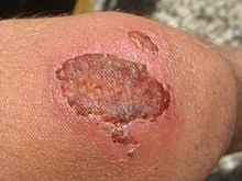 Possible causes of eschar (medical symptom) an eschar is a slough or piece of dead tissue that is cast off from the surface of the skin, particularly after a burn injury, but also seen in gangrene. Wound Healing Wikipedia