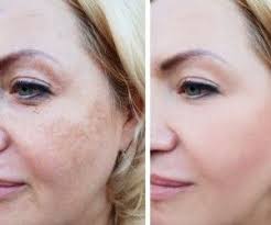 الدكتور عماد ميزاب يقدم خلطة زيوت تقضي على الشيب بدون خلطات معقدة Pigment Treatment Instagram