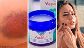 Vicks vaporub est déconseillé au cours de la grossesse et chez la femme en âge de procréer n'utilisant pas de contraception efficace (voir rubrique fertilité, grossesse et allaitement). 11 Utilisations Incroyables Du Vicks Vaporub Vicks Vaporub Exercices Visage Douleurs Musculaires