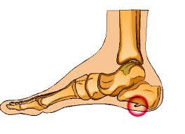Nonsurgical treatment for bone spurs. Bone Spurs Symptoms Causes And Treatments In Dallas Plano Texas