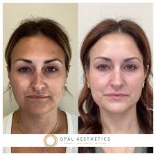 Crystal Sponamore BSN, RN (@crystal_injects) • Instagram photos and videos