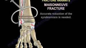 Fracture of lower leg, part unspecified: Ankle Fractures Special Situations Everything You Need To Know Dr Nabil Ebraheim Youtube