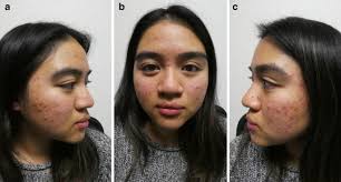 Because of the risk of teratogenicity, patients, pharmacists, and prescribers must register with the u.s. Acne Vulgaris A Patient And Physician S Experience Springerlink