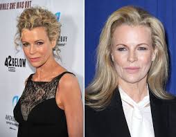 This video explains the logic involved in the androgen insensitivity syndrome (ais).did you found this helpful? Kim Basinger Plastic Surgery Celebrity Plastic Surgery Kim Basinger Celebrity Plastic Surgery Plastic Surgery