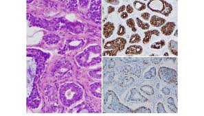 Ceruminous Adenocarcinoma Adenoid Cystic Carcinoma Type H E 9200 Download Scientific Diagram