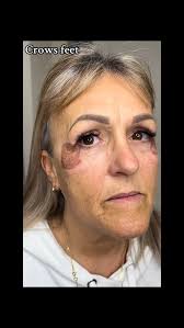 Benefits for crow’s feet: 1. Non-surgical: It offers a surgical-like  tightening effect without incisions, anesthesia, or surgery. 2. Immediate  and long-lasting results: Initial tightening is seen ...