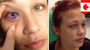 Eyeball tattootoday we talk a bit about the tattooing of the scleral, the eye ball, corneal. Eye Tattoos Risks Pain And Are They Worth It