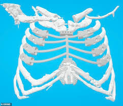 The rib cage is the arrangement of ribs attached to the vertebral column and sternum in the thorax of most vertebrates, that encloses and protects the vital organs such as the heart, lungs and great vessels. Uk Patient Becomes Sixth Person In The World Fitted With 3d Printed Rib Cage Implant 3d Printing Industry