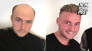 But the oily spots looking flat and fake isn't a problem anymore and if i use hold spray they stay in popular bald hairstyles for men. Bald Guys Are Wigging Out For These Believable Hairpieces From Quiff And Co New York Post Youtube