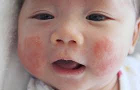 Bagaimaba cara menghilangkan panu dikulit? Macam Panau Tapi Bukan Ini 5 Perkara Tentang Tompokan Putih Pada Muka Anak