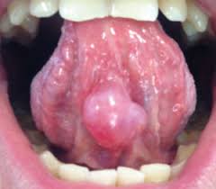 Les atlas de dermatologie canine dénombrent de nombreuses affections à l'origine de la présence d'un ou plusieurs nodules sur. Une Boule Sous La Langue L Information Dentaire