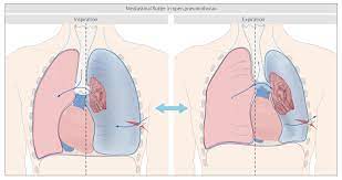 A primary pneumothorax is considered the one that occurs without an apparent cause and in the absence of significant lung disease. Pneumothorax Knowledge Amboss