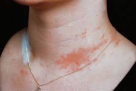 The Connection Between Nickel Allergies Digestive Problems Skin Allergies Home Remedies For Skin Nickel Allergy