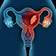 This kind of anemia is caused by an iron. Uterine And Endometrial Cancer Saint John S Cancer Institute Santa Monica Ca