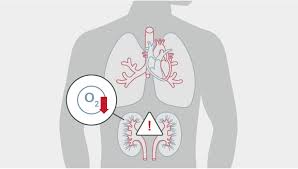 Shock Management | Edwards Lifesciences