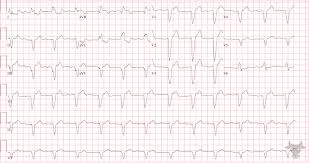 Image result for Left Bundle Branch Block