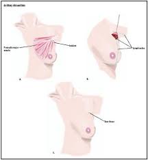 Breast pain is not usually a sign of cancer and is more commonly related to hormonal changes or simple mastalgia. Axillary Dissection Procedure Recovery Blood Removal Pain Operation Cells Risk