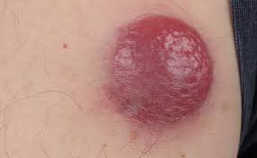 Image result for Merkel Cell Carcinoma