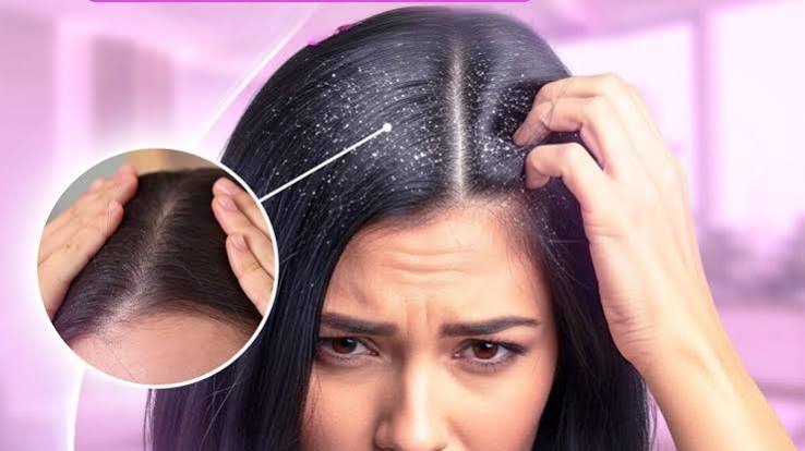 قشرة الشعر | أسبابها وطرق التخلص منها - مركز نضارة للجلدية والليزر والتجميل بالغردقة
