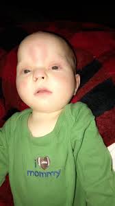 China is diagnosed with Wolf-Hirschhorn syndrome. As a result, she is  missing part of her 4th chromosome and is nonverbal. This hasn't prevented  China from influencing those around her with her innately