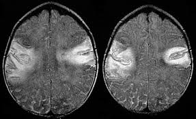 The peak incidence of herpes simplex encephalitis (hse) occurs in very young children and adults over the age of 50 years with both sexes equally affected and have an. Radiology In Ped Emerg Med Vol 7 Case 9
