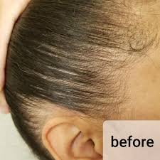 It blocks dht, a hormone that kills hair and can disrupt you can't find any criticism of the vita hair brush anywhere else. Ultima 12 Lasercomb Hairmax