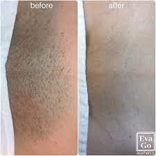 We did not find results for: Laser Hair Removal Treatment For Bikini Evago Aesthetics Facebook