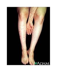 How To Find Out For Sure If Your Itchy Rash Is Caused By Gluten Gluten Rash Dermatitis Herpetiformis Itchy Rash