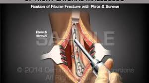 However, only one case was worse than. Open Reduction Internal Fixation Of Right Lateral Malleolus Medical Animation