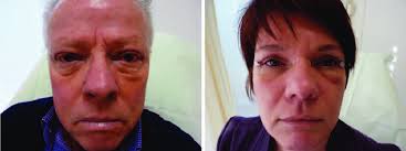 Kathy bates's short cropped haircut. A 69 Year Old Man Left And A 44 Year Old Woman Right 1 Week After Download Scientific Diagram