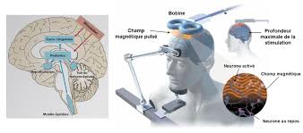Sismotherapie — sismothérapie la sismothérapie, ou électrochoc (du gr. Stimulation Magnetique Transcranienne Ch Theophile Roussel