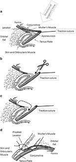 Minimal Incision Posterior Approach Levator Plication For