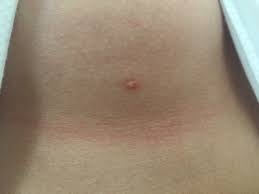 Seit Jahren Pickel Mit Loch Unter Brust Fotos Was Ist Das Haut Sorgen Dermatologie