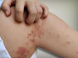 Image result for Skin Infection