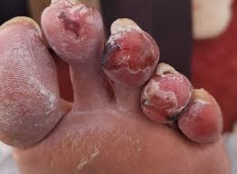 Image result for Chilblains