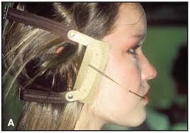 JCO Pearl: Welded Stop for J-Hook Headgear Safety