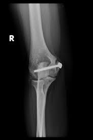 Between the medial epicondyle and distal humerus. Medial Epicondyle Nonunions In Children Case Report With Overview And Management Abstract Europe Pmc