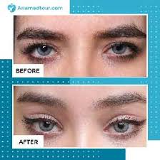 This section introduces the main cosmetic and reconstructive procedures that cc kat performs at her birmingham based cosmetic surgery practice. Canthoplasty In Iran Top Eyelid Surgeons Ariamedtour