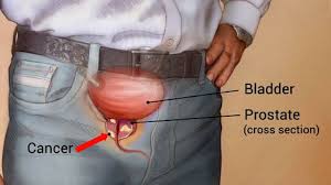 A frequent or excessive need to urinate, during the day and/or at night difficulty in starting, maintaining, or stopping the urine stream a weak or interrupted urine stream Early Signs And Symptoms Of Prostate Cancer That You Shouldn T Ignore Canceris
