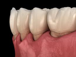 Dental cavities happen when plaque forms between your teeth and on your gums. Gum Disease Receding Gum Line Jacksonville Dental Specialists