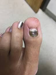 Image result for Onychotillomania feet