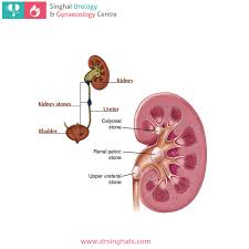 Kidney Stone Kidney Stones Bladder Surgery Doctor
