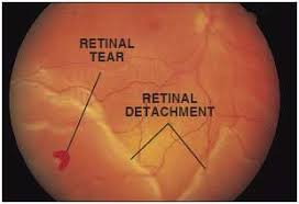 Image result for Retinal Detachment